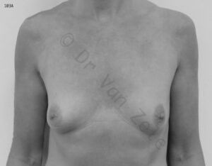 van-zele-borst-vergroting-breast-augmentation-mammaire