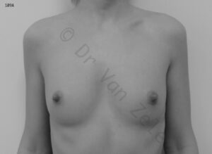 van-zele-borst-vergroting-breast-augmentation-mammaire