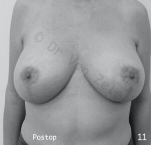 borst-vergroting-lift-pexie-seins-augmentation-breast