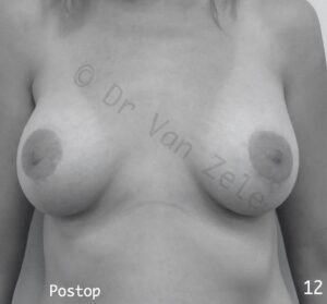 borst-vergroting-lift-pexie-seins-augmentation-breast