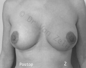 borst-vergroting-lift-pexie-seins-augmentation-breast