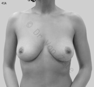 van-zele-borst-vergroting-breast-augmentation-mammaire