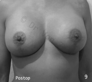 borst-vergroting-lift-pexie-seins-augmentation-breast